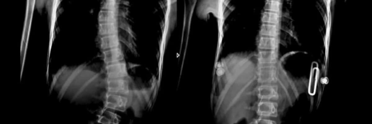 Skolyozda braket müalicəsi