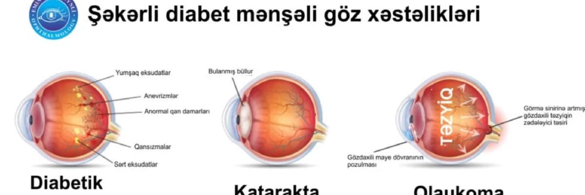 Şəkərli diabet və hipertonik retinopatiyalar