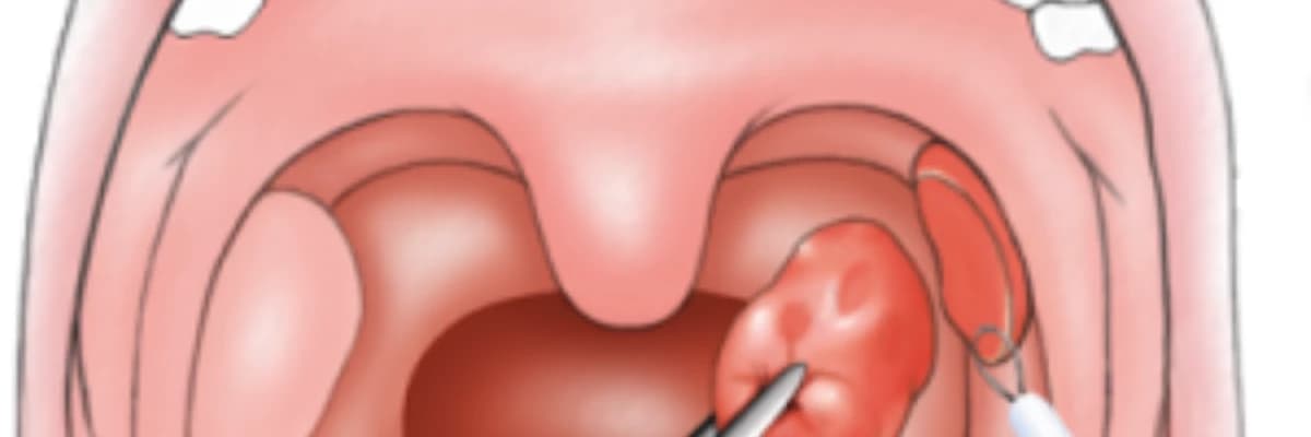 Tonsillotomiya nədir?