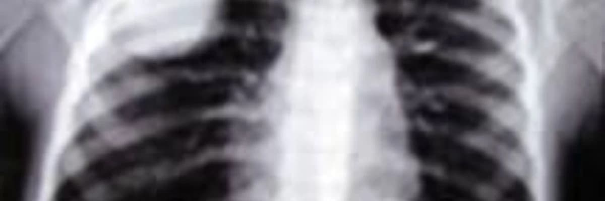 Qabırğaların sınıqları