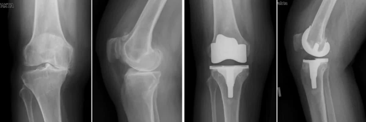 Diz Artroplastiyası: Birgə Sağlamlığı Bərpa edən Cərrahi Müdaxilə