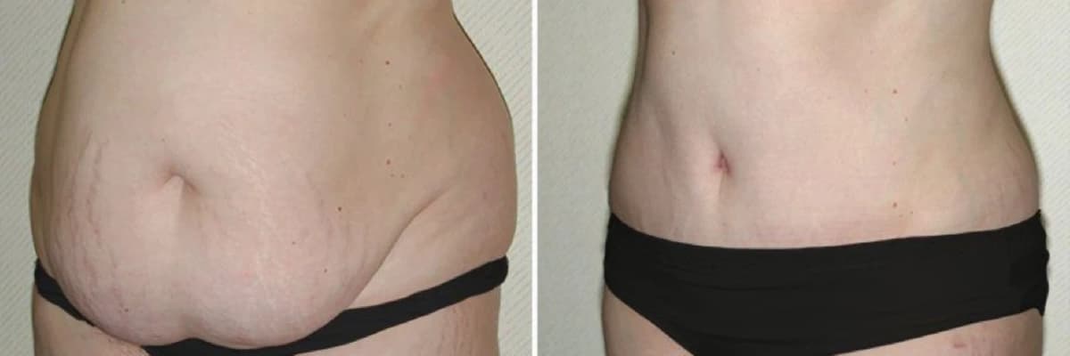 Qarın gərmə - Mini Abdominoplastika, Tam Abdominoplastika, Full Abdominoplastika body plastika