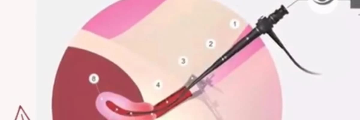 Histeroskopiya Nədir?