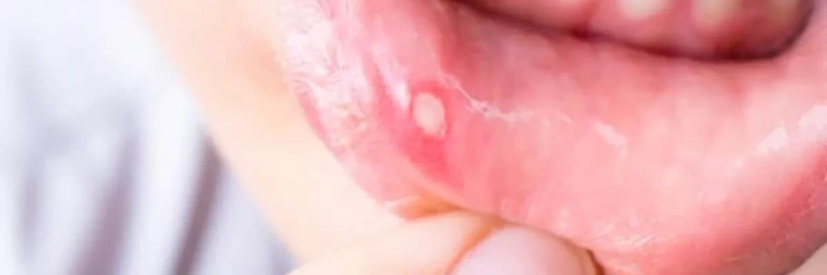 Ağız yaraları: müalicə, qarşısının alınması və səbəbləri haqqında nə bilmək lazımdır