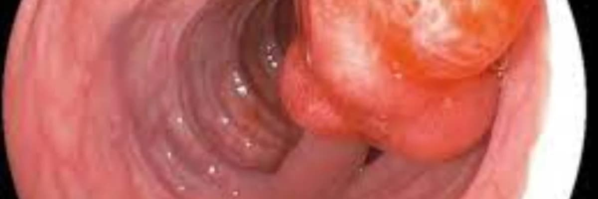 Yogun bagirsagin sisleri