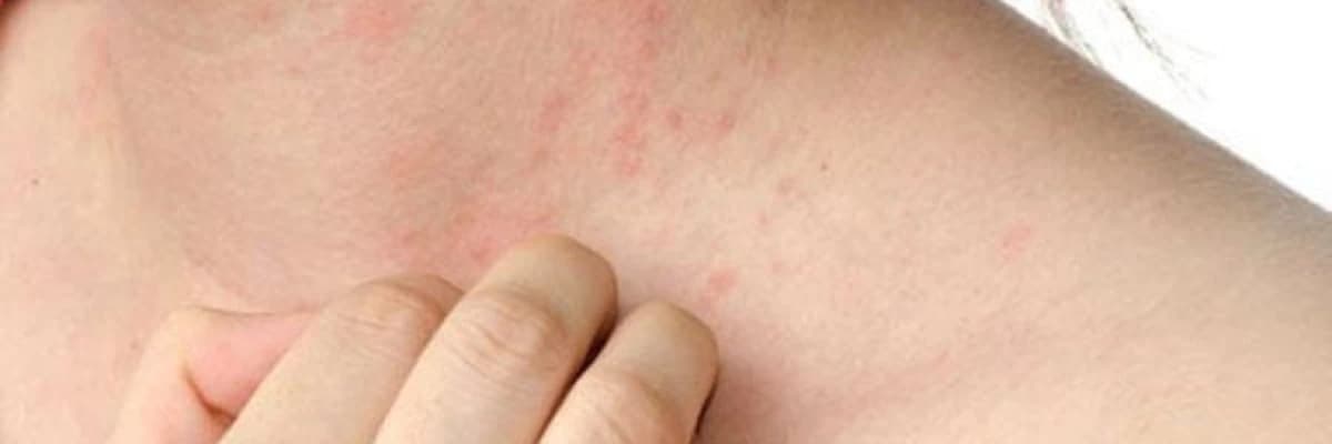 Xərçəng yaraları