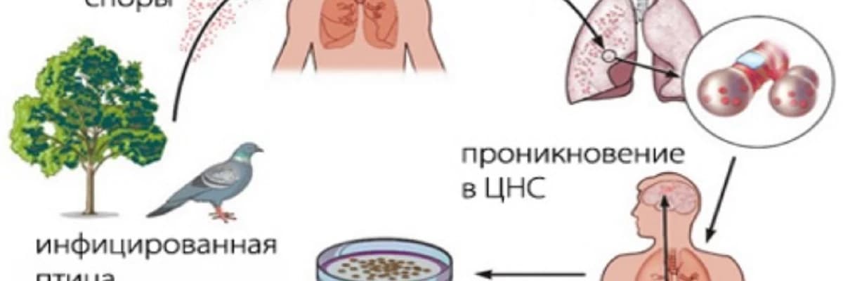 Ornitoz - quşçuluq işçiləri, quşların yetişdirilməsi ilə əlaqəli fermerlər üçün xarakterik olan kəskin xlamidial infeksiya