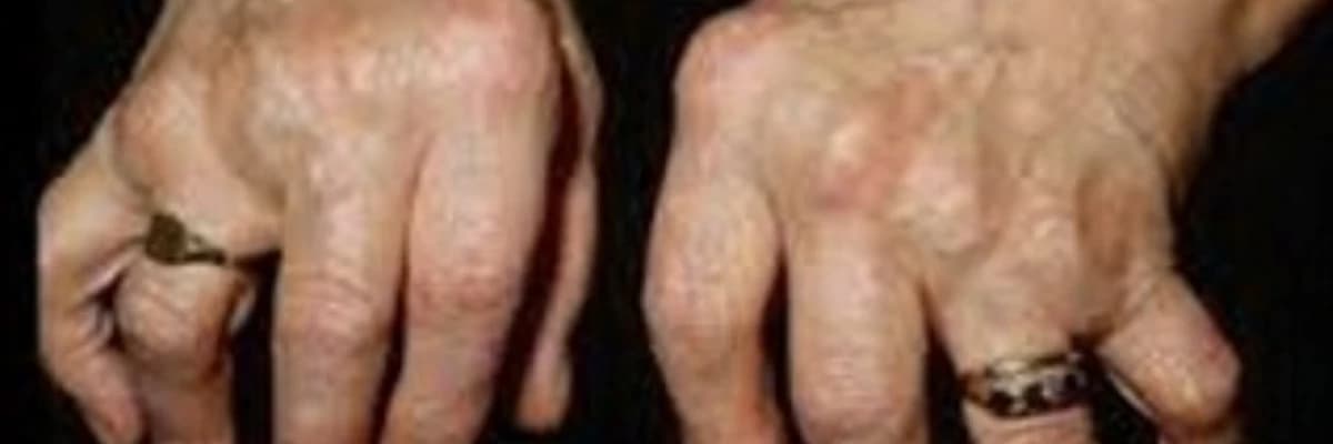 Revmatik Xəstəliklər: Növü, Simptomlar və Müalicə Yolları