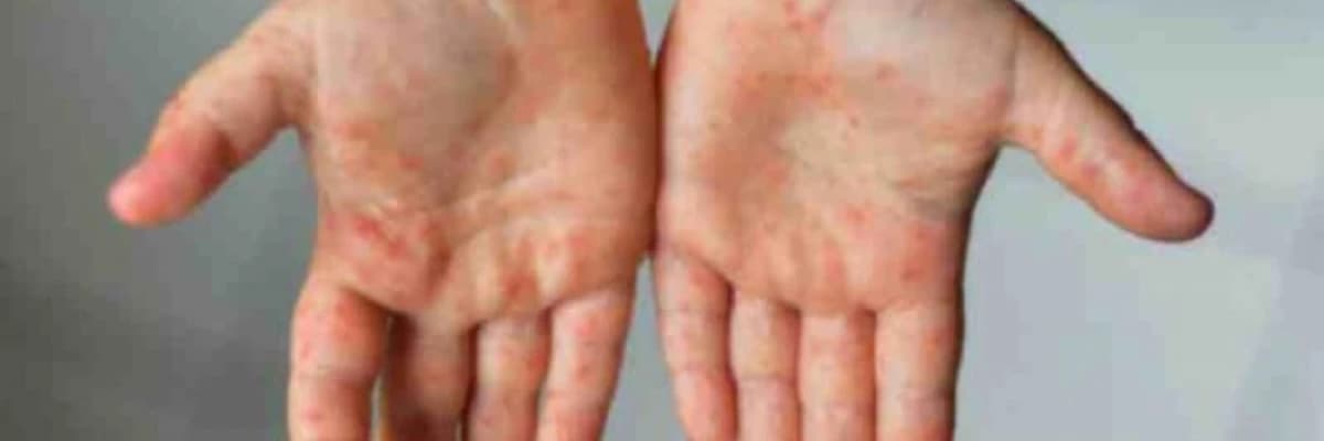 Kavasaki xəstəliyi