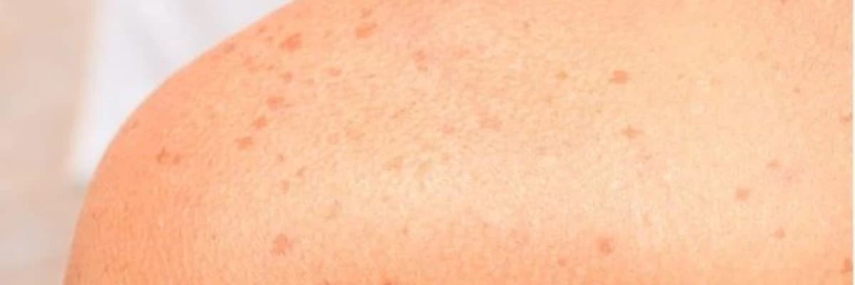 Günəş, hamiləlik və yaş ləkələri