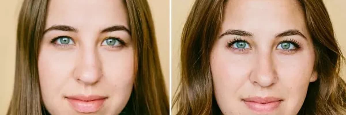 Ətli Burun Rinoplastikası