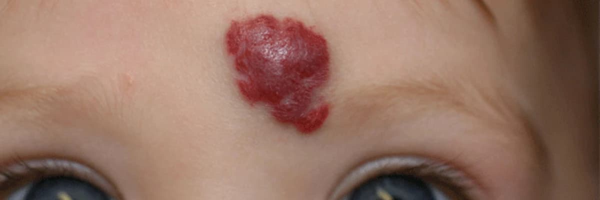 Hemangiomaların Müalicəsi: Yanaşmalar və Müalicə Metodları