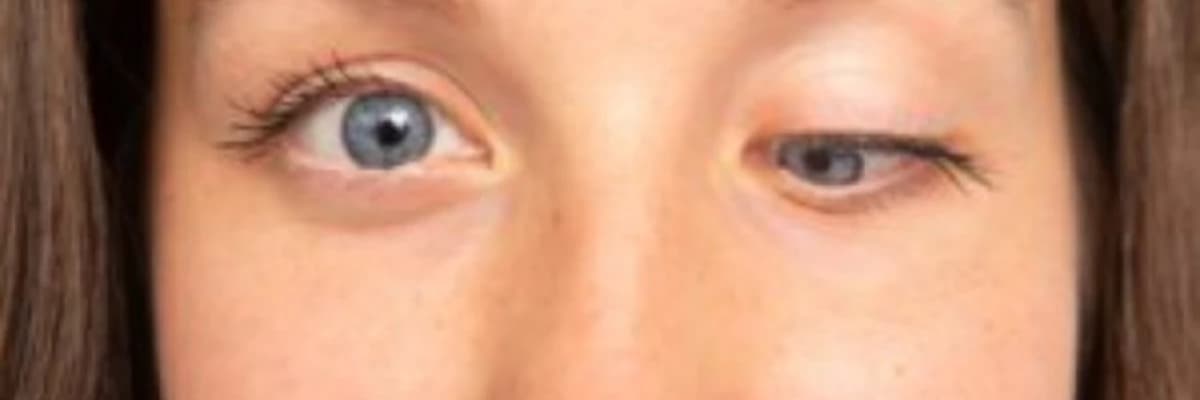 Tiroid göz xəstəliyi