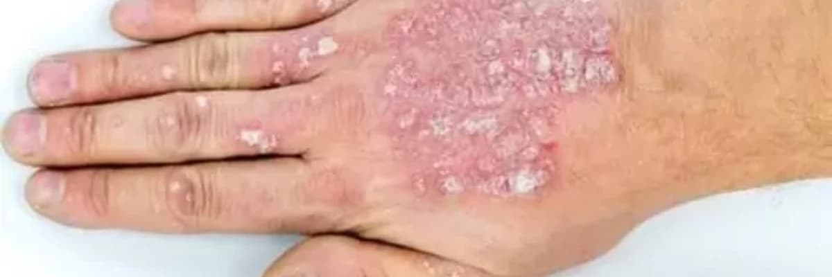 Pullu dəmrov (Psoriaz) haqqında