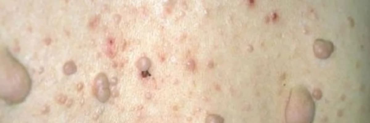 Dəri şişləri və xərçəngləri