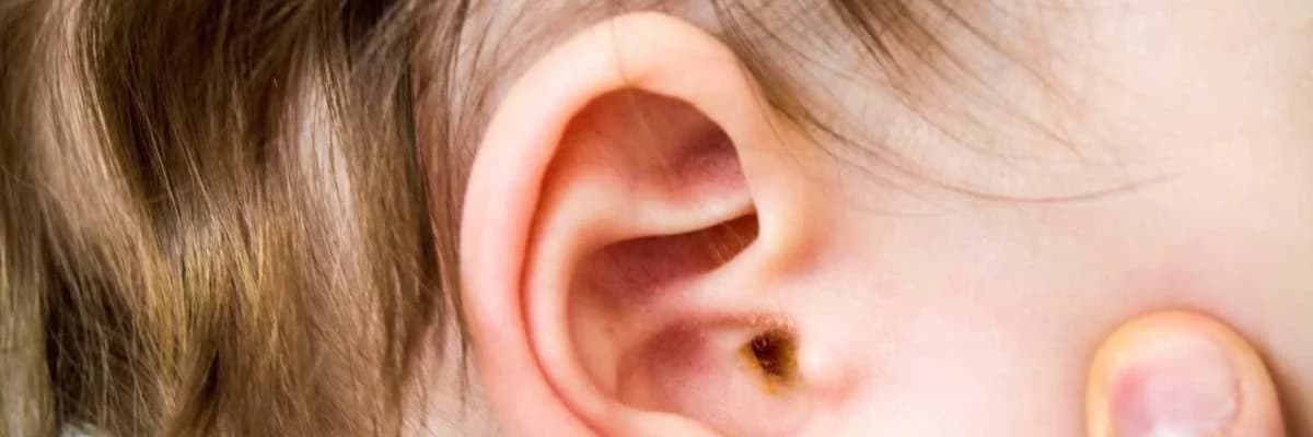 Orta qulaq iltihabı nədir?