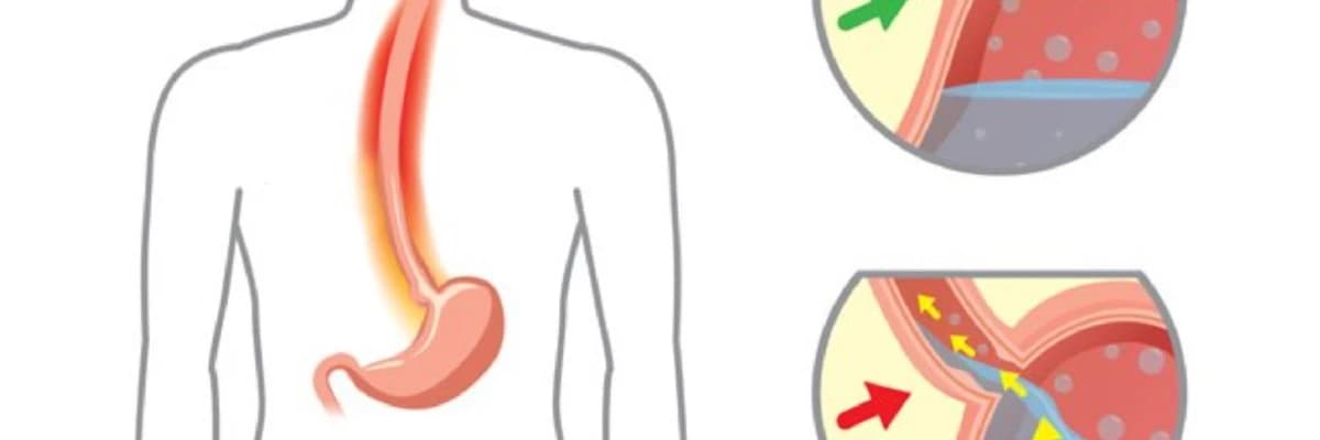 Qastroezofageal reflü xəstəliyi (GERD)