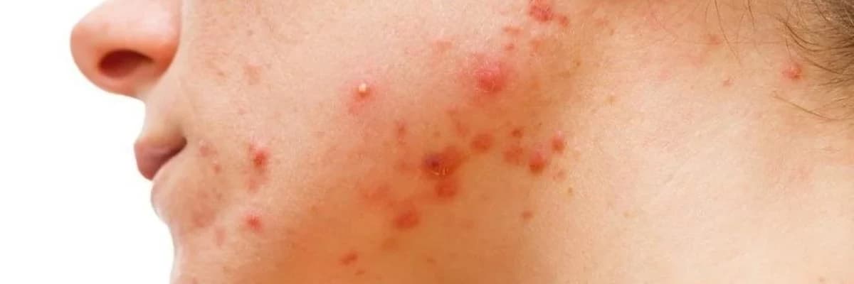 Yeniyetmələrin üzləşdiyi sızanaq problemi - necə müalicə olunur?