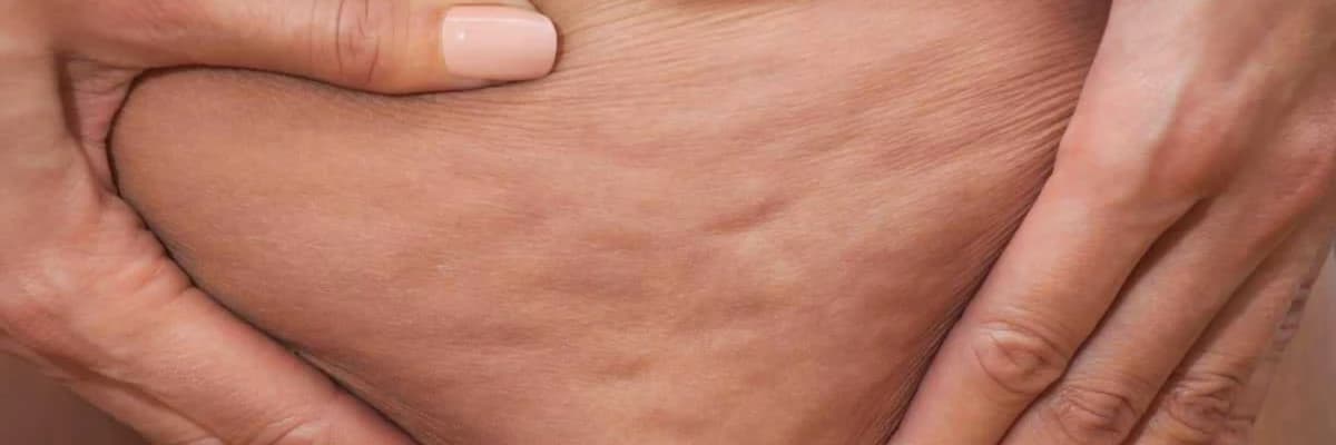 Selülit nədir? Niyə qadınlarda daha çox görülür? Selülit müalicəsi və tez-tez verilən suallar