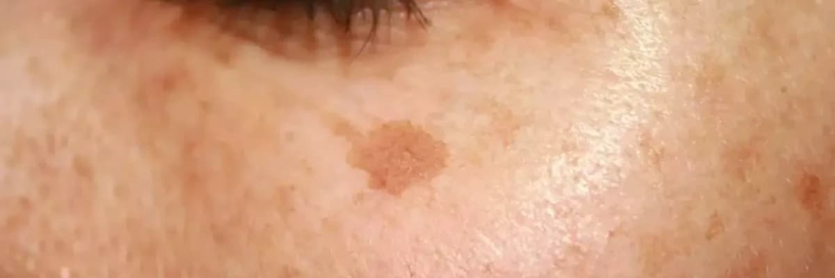 Günəş ləkələri: əmələ gəlməsi, qarşısının alınması və müalicəsi