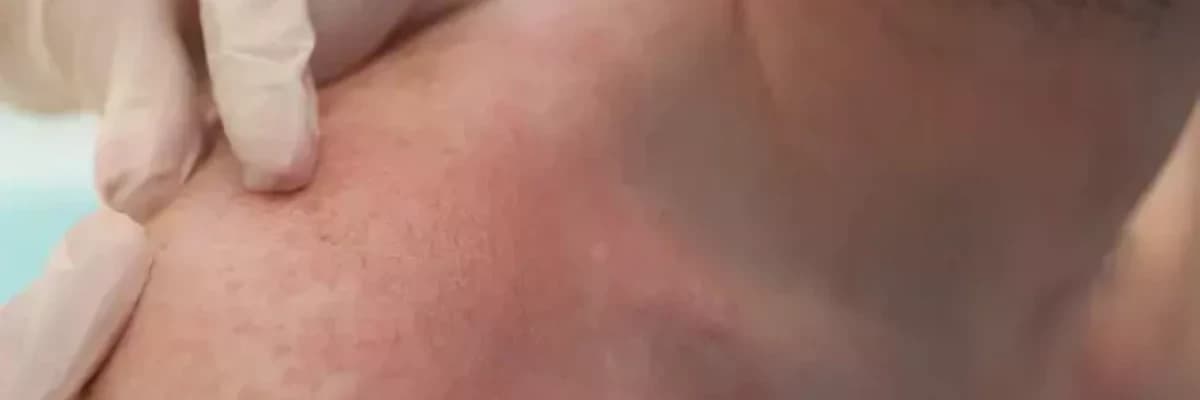 ANAFLAKSİYA (allergik şok)