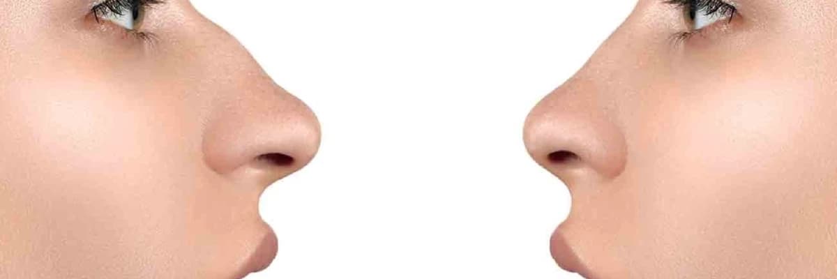 Estetik Burun Cərrahiyyəsi: Yenidən Formalaşdırma və Sağaltma Sənəti