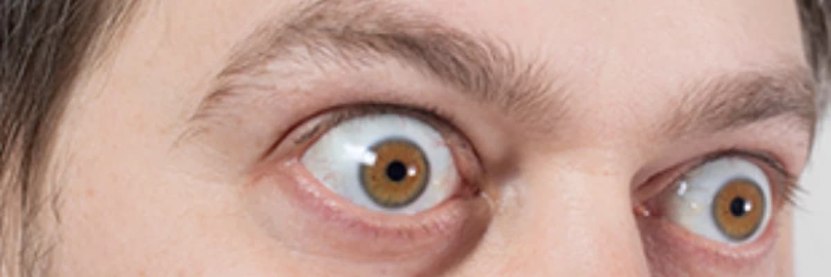 Tiroid Oftalmopatiyası