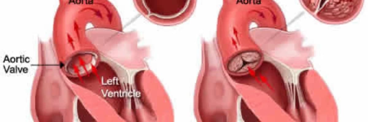 Aorta çatışmamazlığı və darlığı