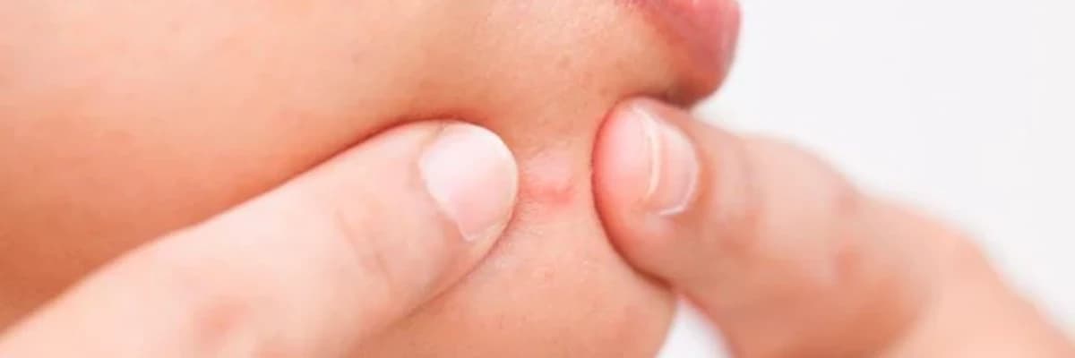 Yetkinlərdəki Sızanaqlar: Yeniyetməlikdən Sonra Davam Eden Akne Problemləri və Onların Müalicəsi