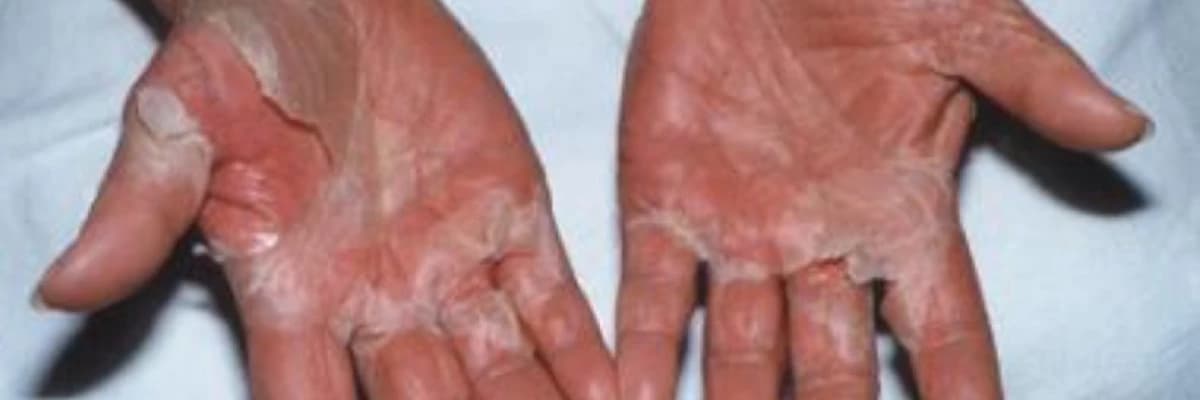 Toksiki şok sindromu nədir?