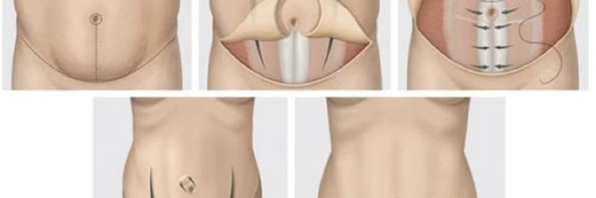 Reverse Abdominoplastika:Abdominoplastika əməliyyatını necə geri qaytarmaq olar
