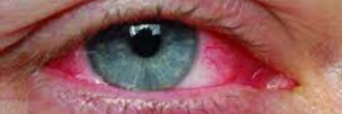 Gözün İrisinin çatışmazlığı və Onun Gətirdiyi Çətinliklər