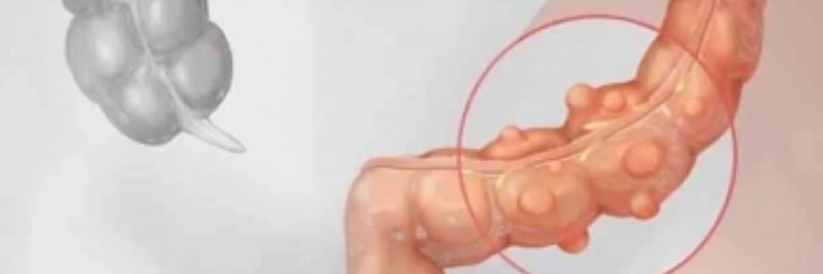 Divertikulit haqqında