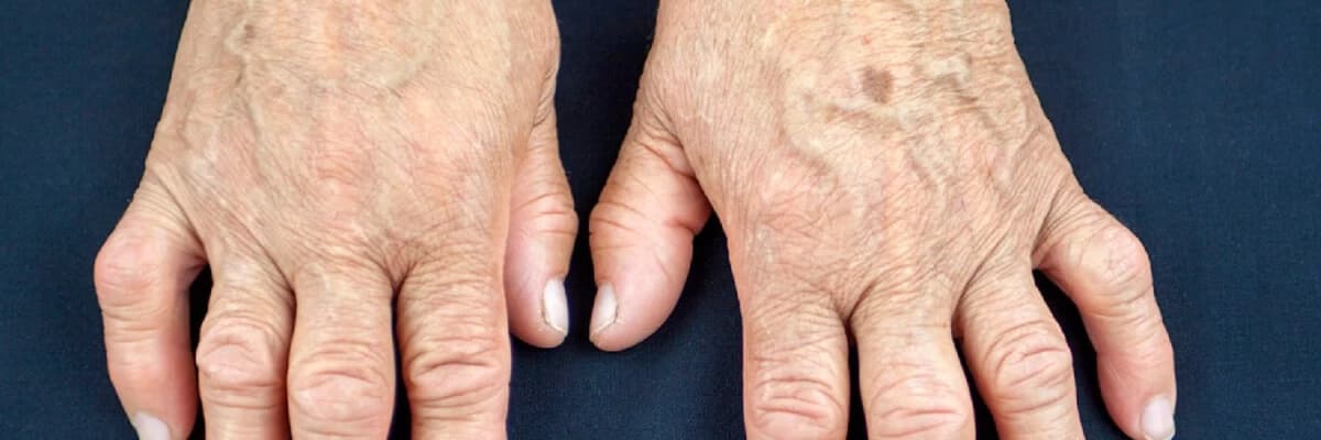 Revmatoid artrit nədir?