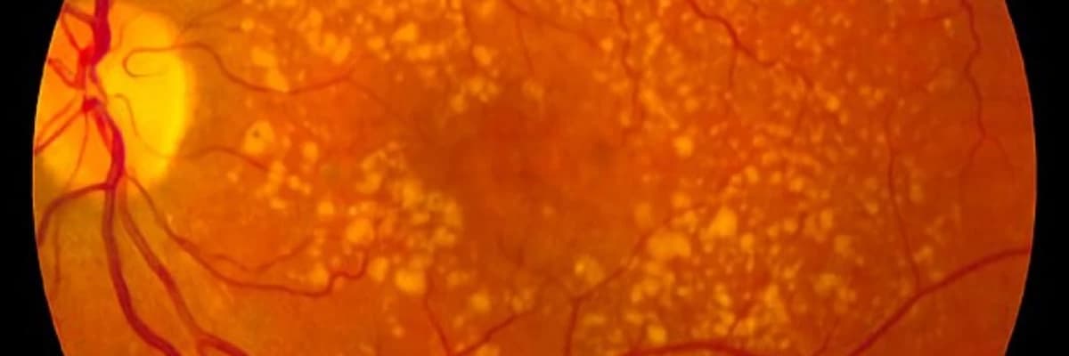 Makula degenerasiyası