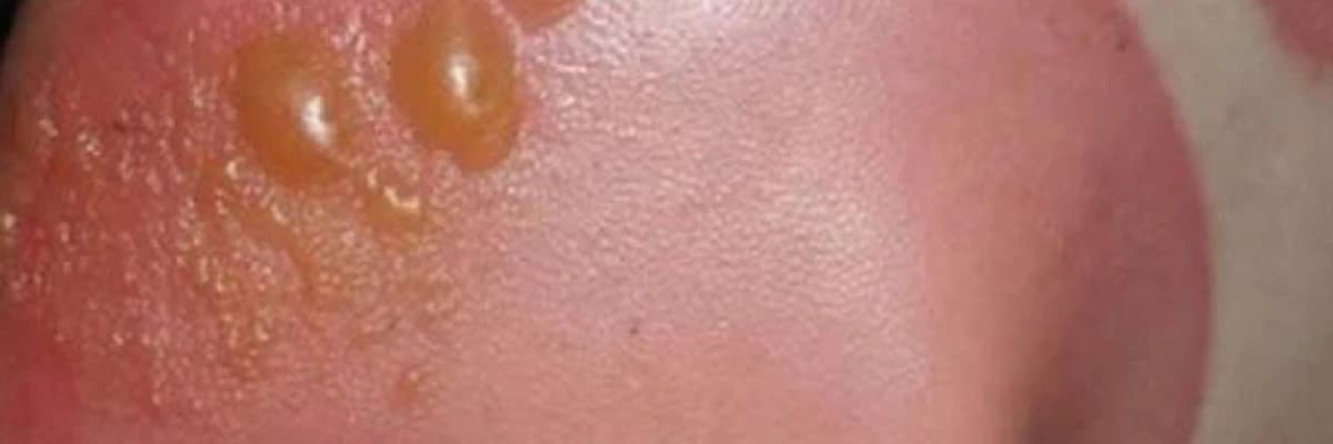 Günəş yanıqları