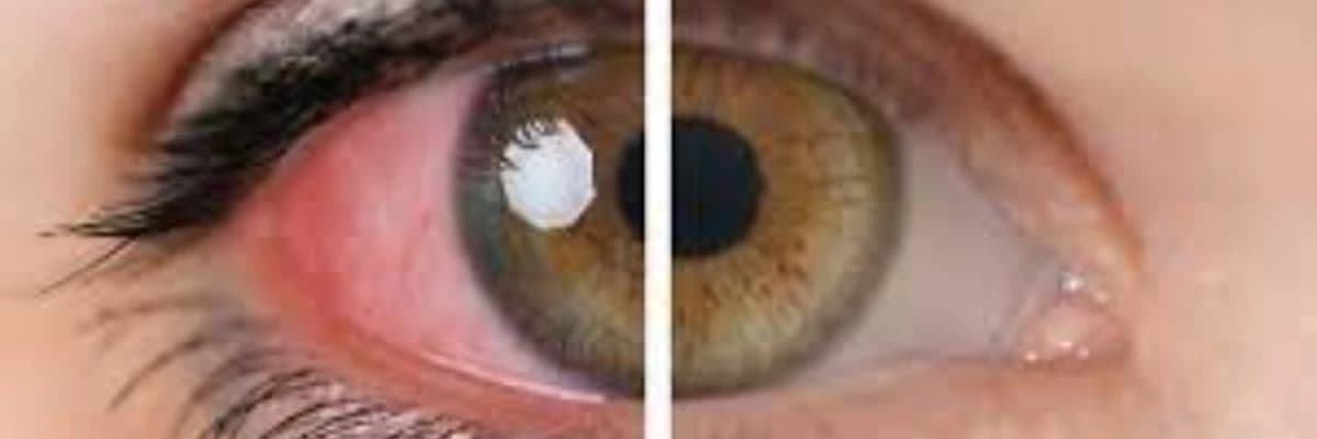 Üveitlərin diaqnostikası və müalicəsi