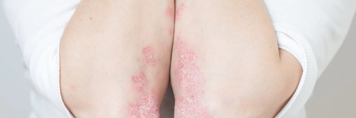 Lupus / sistemik lupus eritematosus