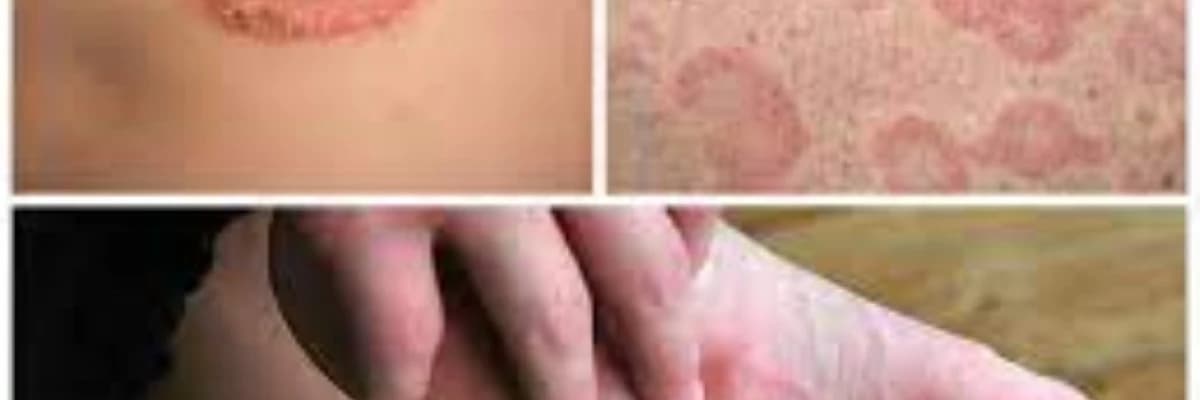 Dərinin göbələk xəstəlikləri