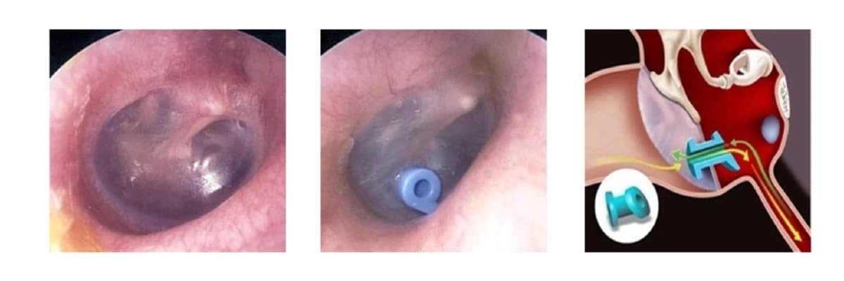 Təpil pərdəsinə ventilyasyon tüpün taxılması (orta qulaqda maye toplanması və adheziv otitlərdə)