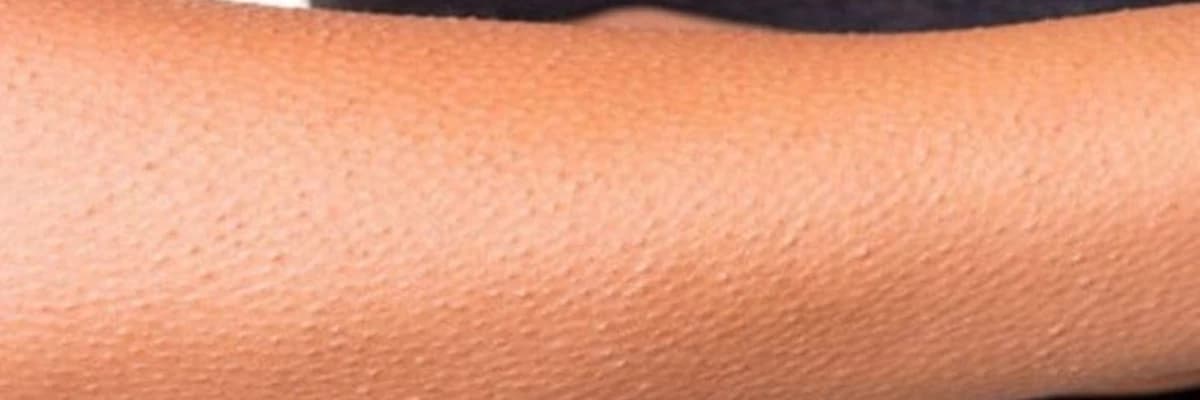 Follikulyar hiperkeratoz nədir?