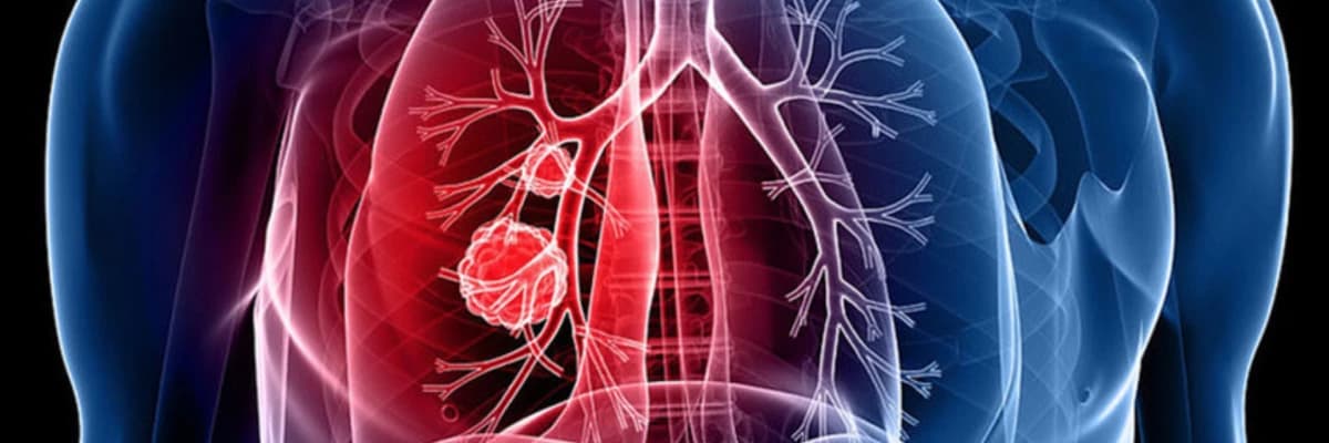 Vərəm: semptomlar, müalicə və profilaktika hələ də dünyada yayılmış bir sağlamlıq problemidir