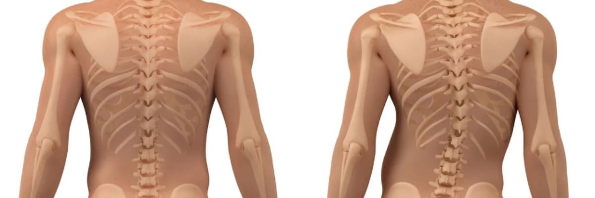 Yetkinlərdə skolyozun cərrahi müalicəsi
