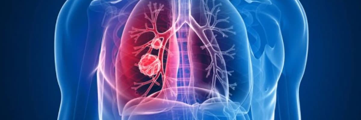 Ağciyər xərçəngi