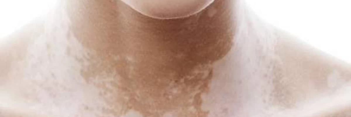 Vitiligo haqqında
