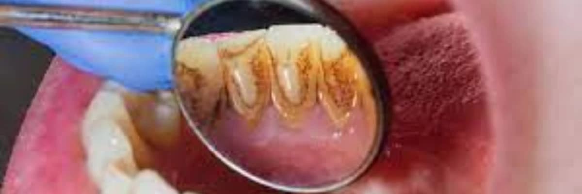 Parodontitin müalicəsi