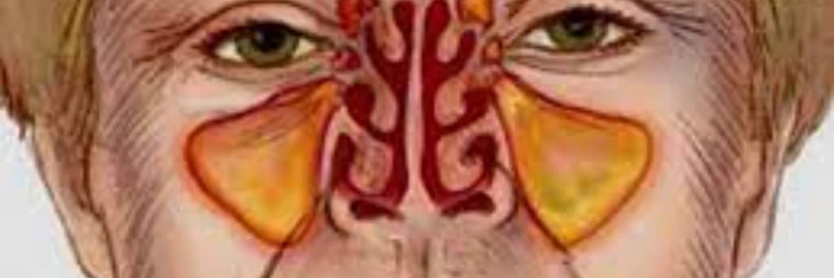 Kəskin və xroniki sinusit (haymorit, etmoidit, frontit)