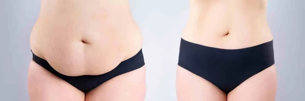 2 pack Lipo ( qadınlarda )