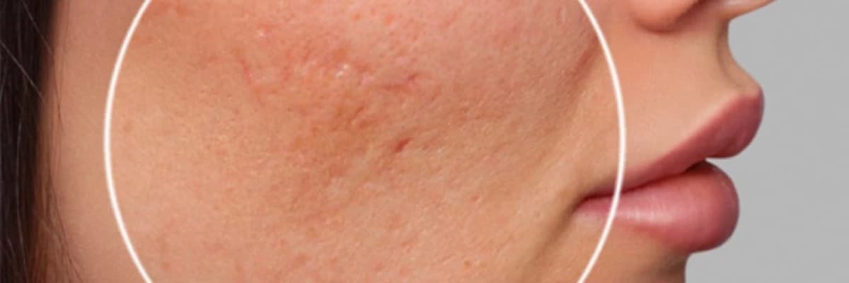 Sızanaq və sızanaq izlərinin müalicəsi