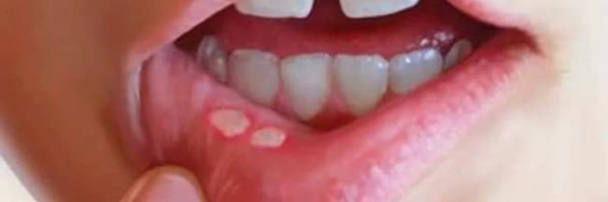 Ağız boşluğunda baş verən göbələk infeksiyaları və onların müalicəsi
